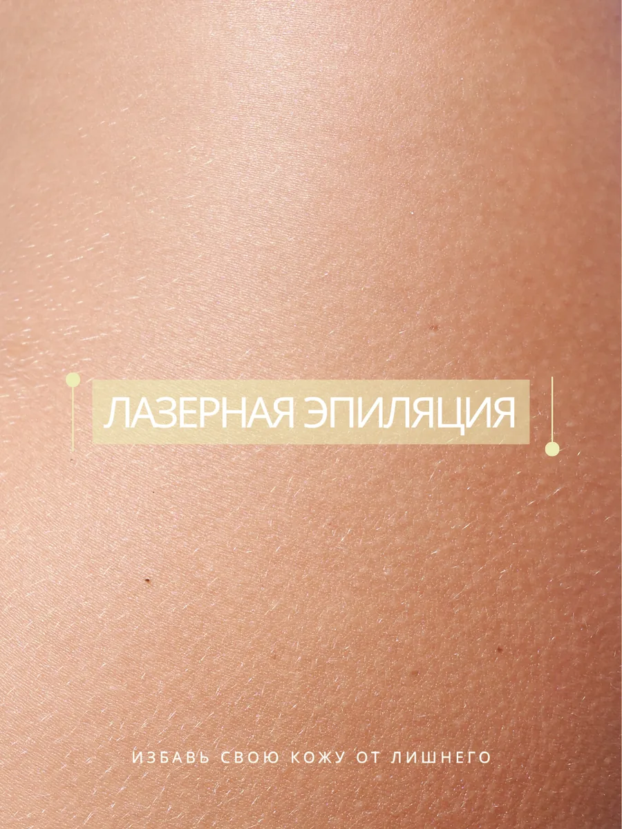 Лазерная эпиляция
